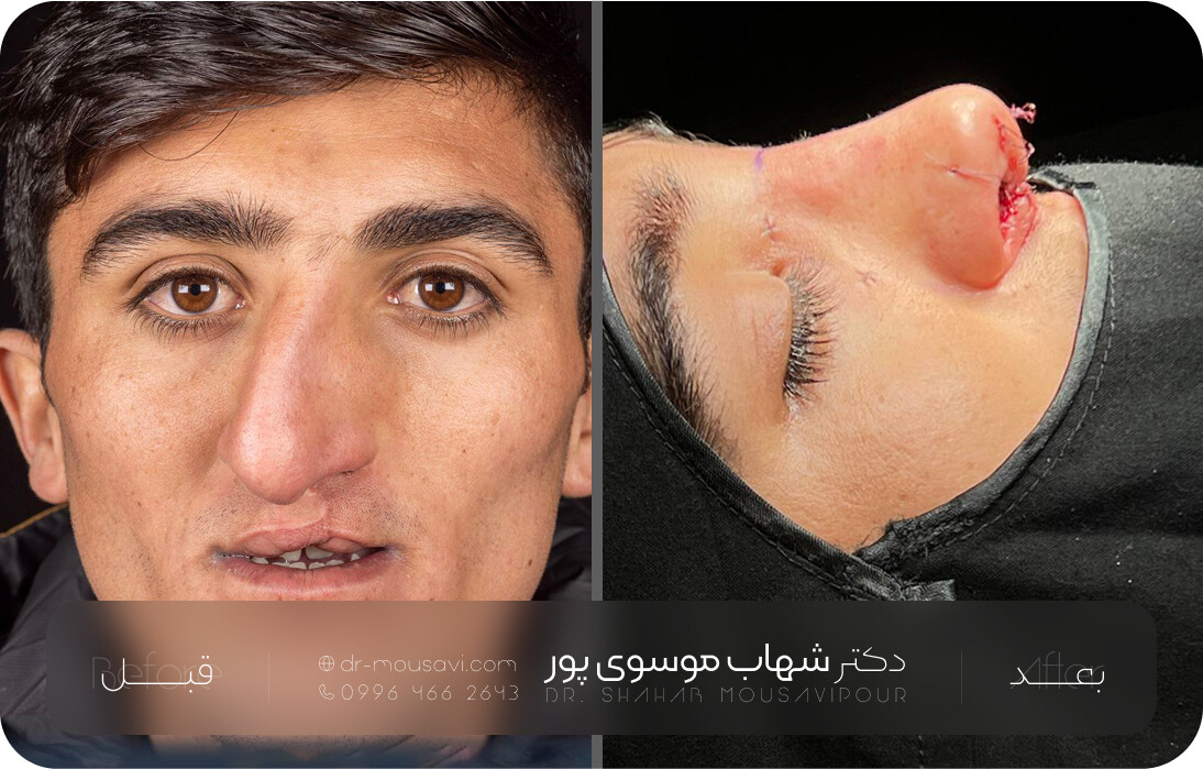 نمونه جراحی بینی – اصلاح قوز و فرم‌ دهی به پل بینی