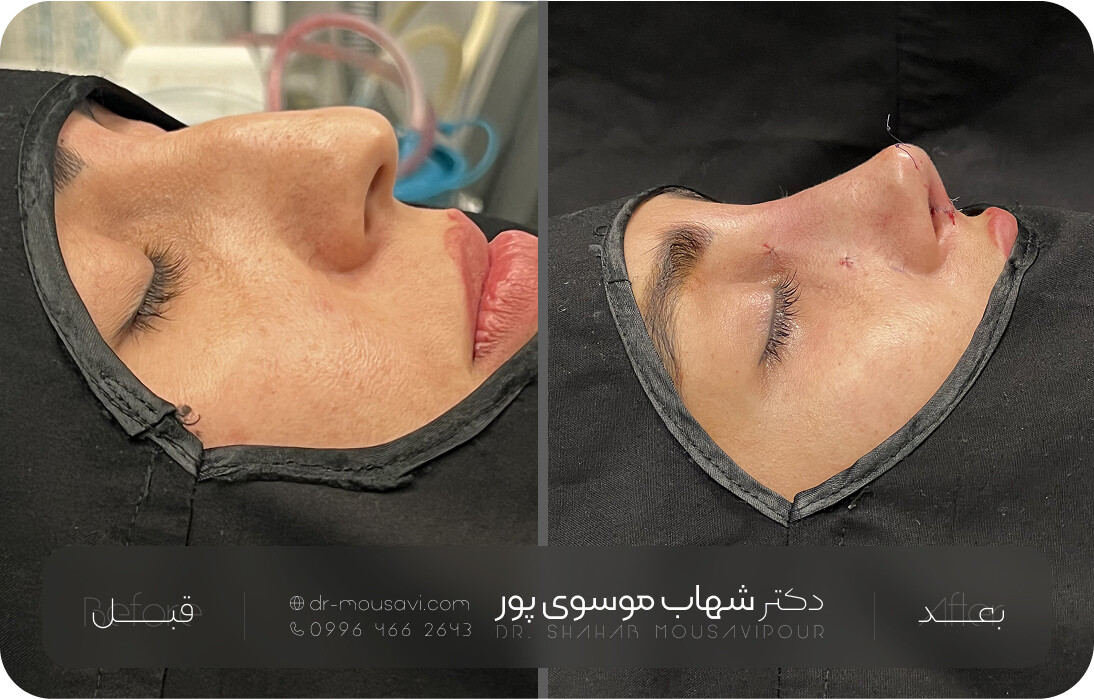 نمونه جراحی پلاستیک – فرم‌ دهی بینی