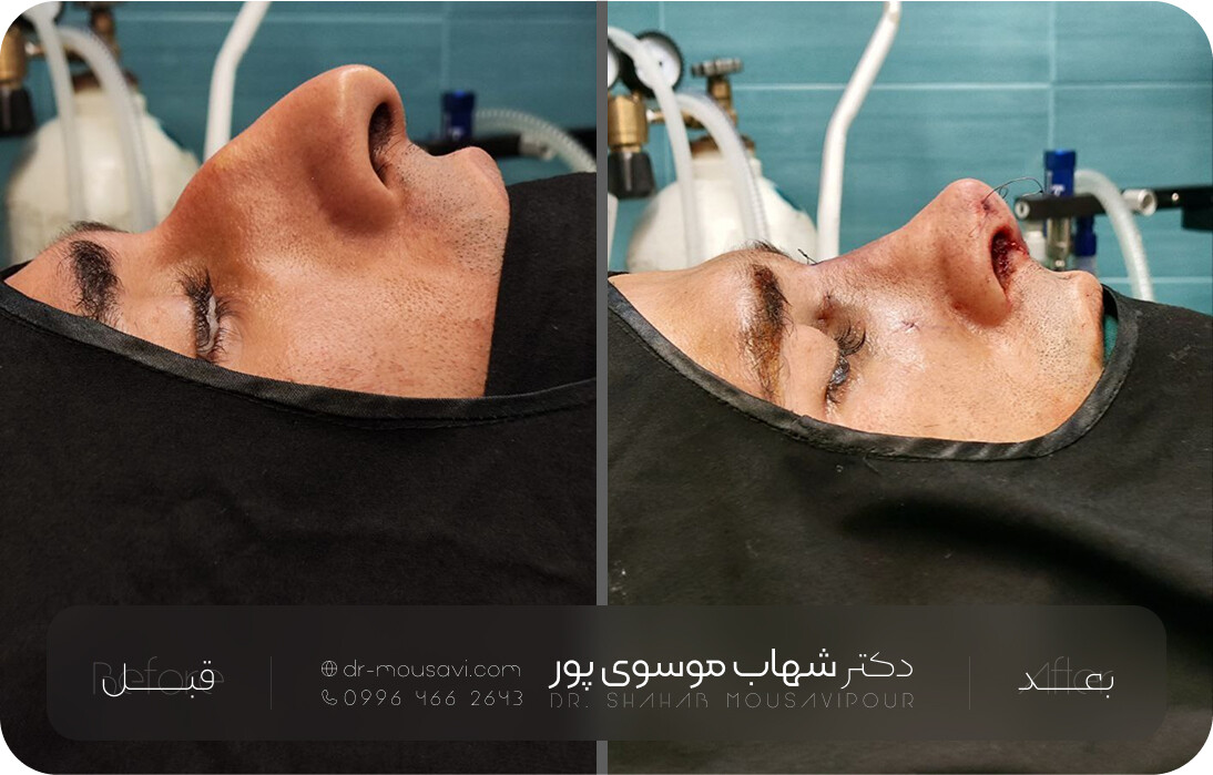 نمونه جراحی زیبایی بینی – اصلاح نوک بینی و انحراف تیغه